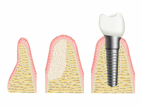 Bone Grafting and Manipulation