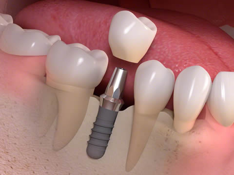 Single Dental Implants