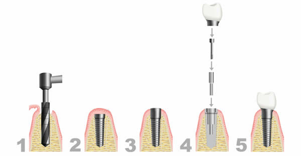 Dental implant treatment process