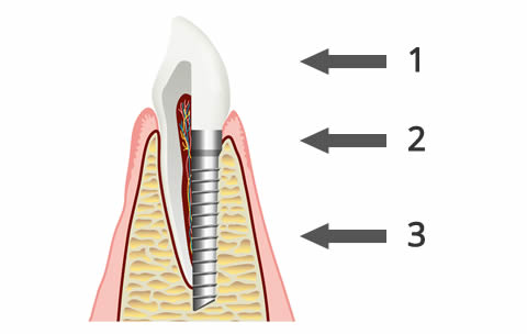 Dental Implant Structure